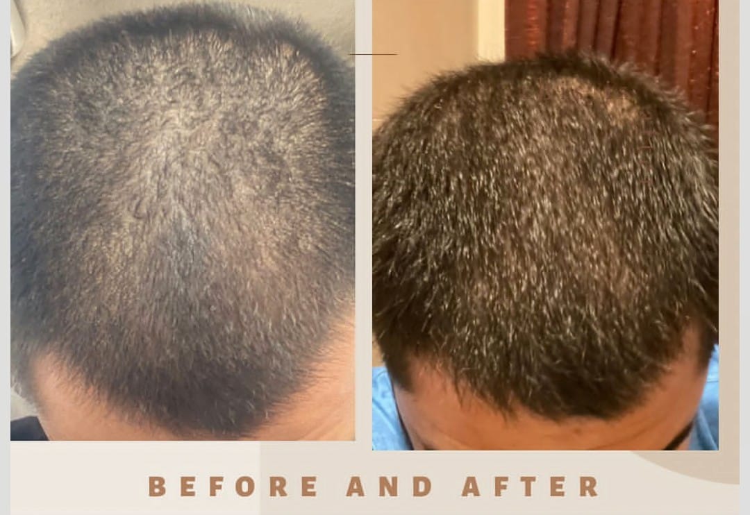 100% Hair Fall Treatment Hair Oil - Image 3